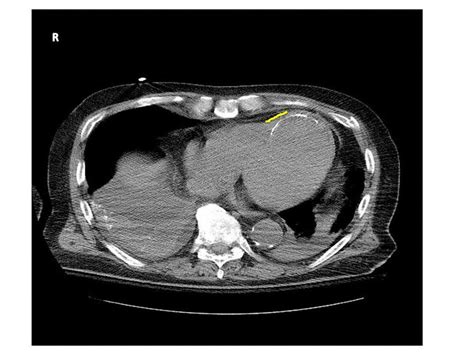 lv ct|left ventricular enlargement imaging.